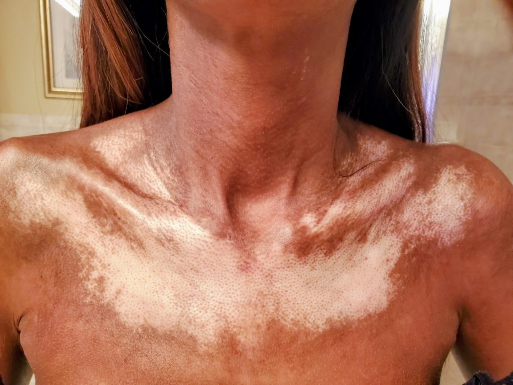 A mum who mistook her rashes and joint pain for stress was diagnosed with a rare incurable disease attacking her vital organs - and has no idea how long she has left.