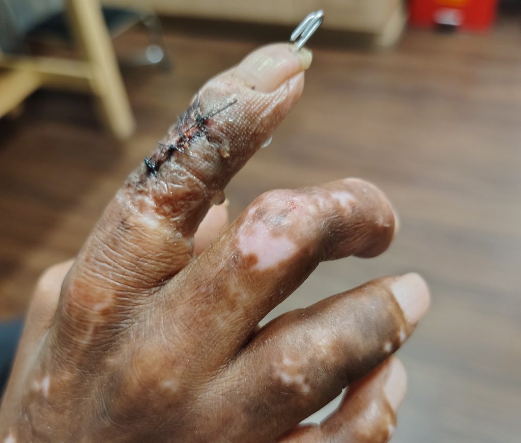 A mum who mistook her rashes and joint pain for stress was diagnosed with a rare incurable disease attacking her vital organs - and has no idea how long she has left.