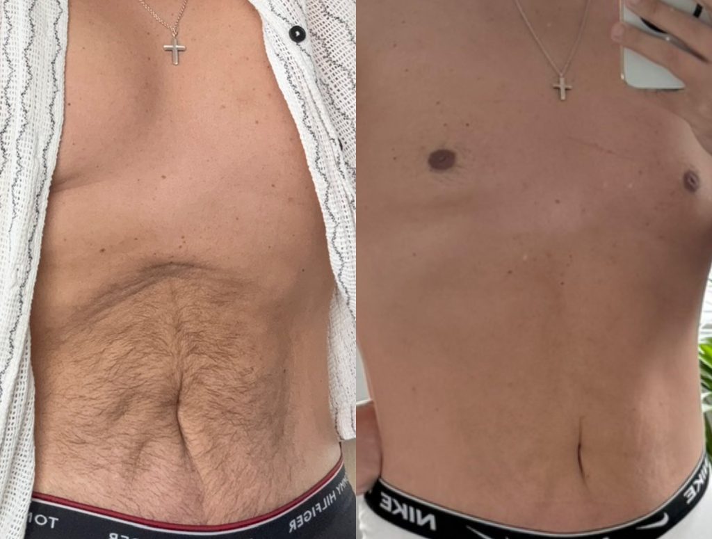 Told he'd never reach 40, a Belfast man lost nine stone on Mounjaro and used a daily six-step skincare routine to avoid surgery - and stunned his tummy tuck surgeons.