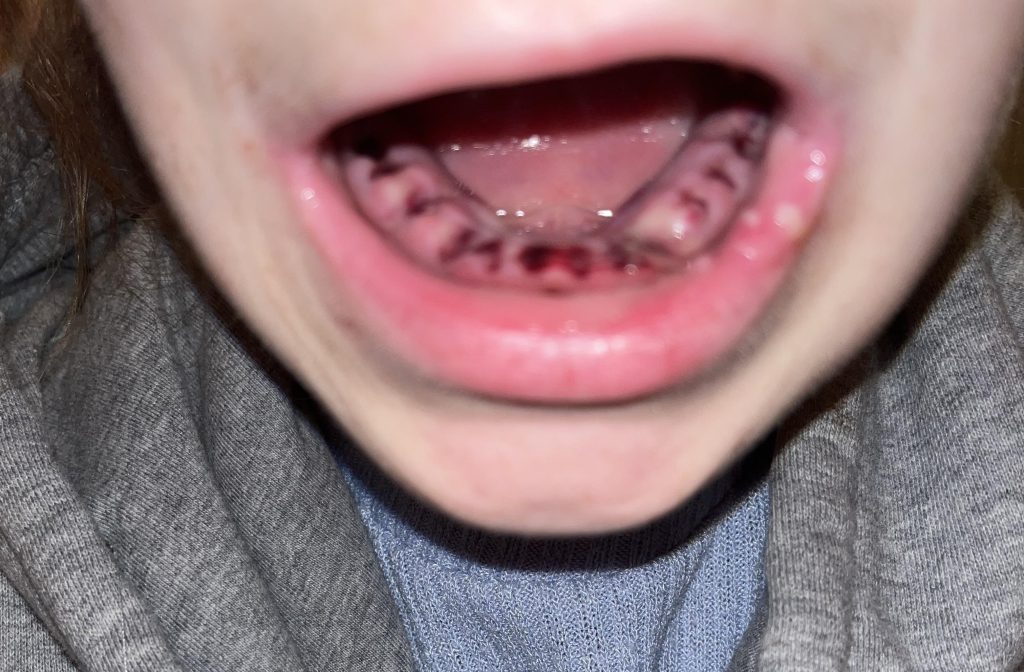 A 25-year-old who had all her teeth pulled at just 22 due to severe vitamin deficiencies is hitting back at cruel online trolls who say she looks 75 and used hard drugs.