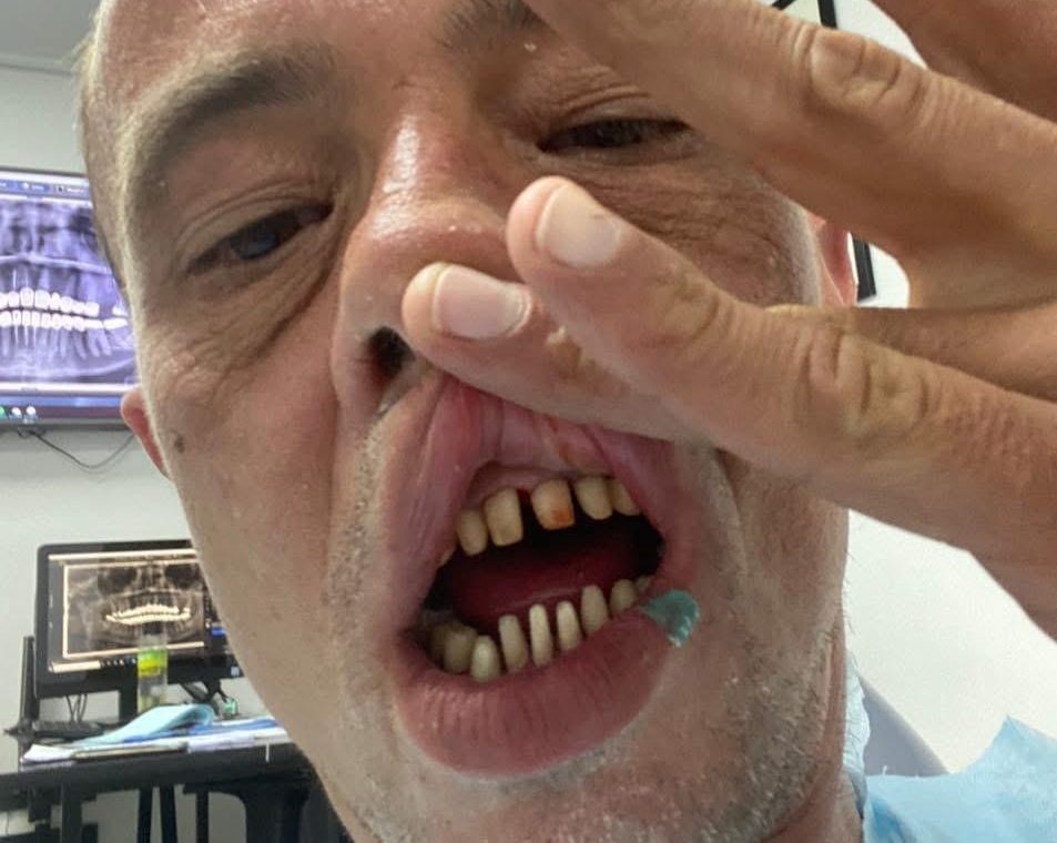 Brit who flew to Turkey for a cheap smile makeover says his teeth are now falling out - and fixing the dental nightmare could cost him up to £40,000.