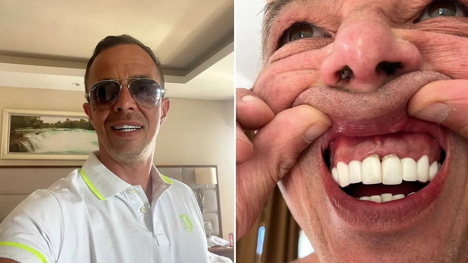 Brit who flew to Turkey for a cheap smile makeover says his teeth are now falling out - and fixing the dental nightmare could cost him up to £40,000.