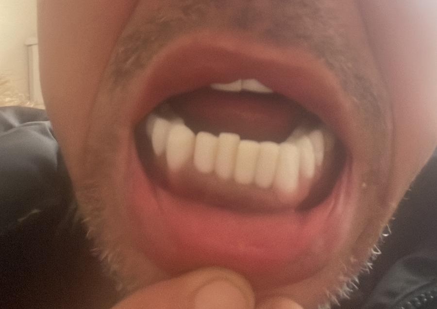 Brit who flew to Turkey for a cheap smile makeover says his teeth are now falling out - and fixing the dental nightmare could cost him up to £40,000.