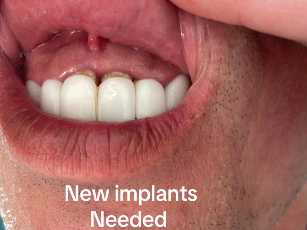 Brit who flew to Turkey for a cheap smile makeover says his teeth are now falling out - and fixing the dental nightmare could cost him up to £40,000.