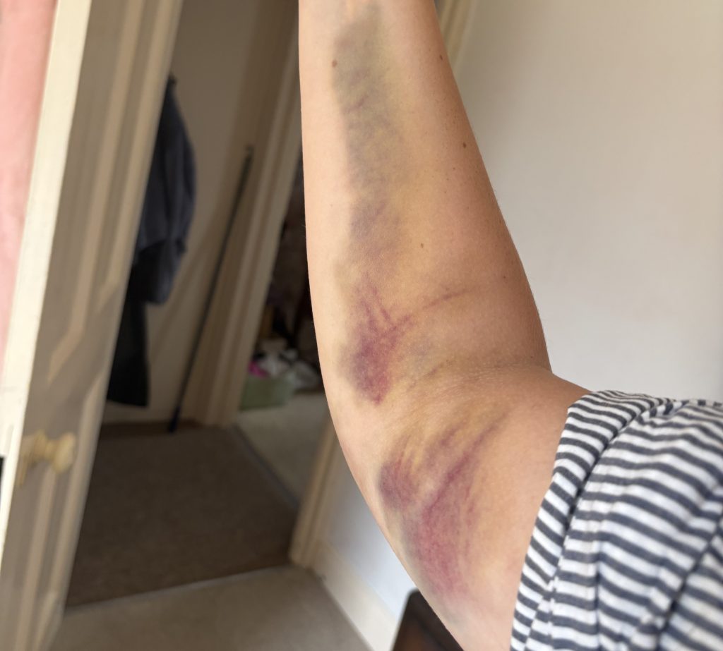 A woman claims she left A&E unable to dress, cook or lift a kettle for weeks after a 'bent' cannula was inserted in her arm - with four nurses insisting it looked fine.