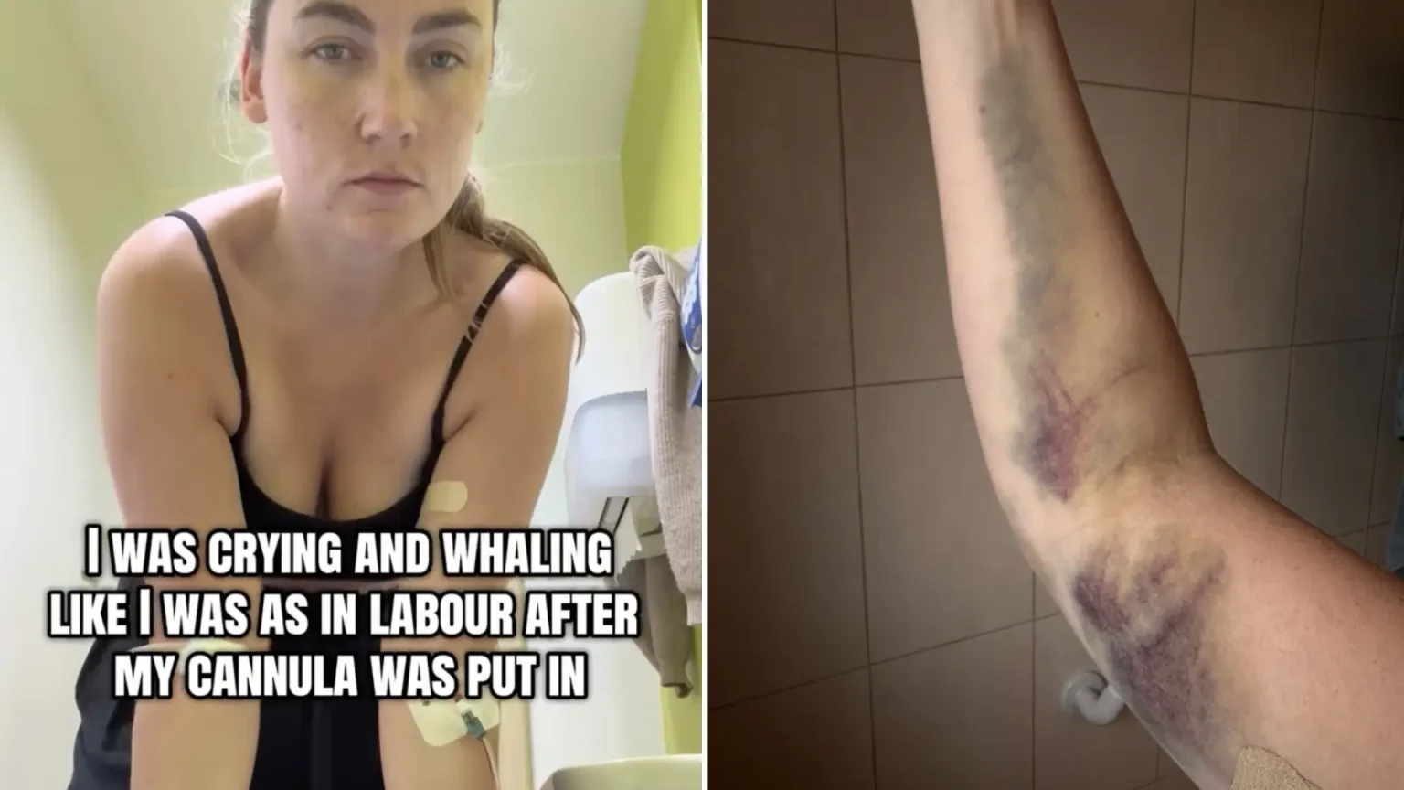 A woman claims she left A&E unable to dress, cook or lift a kettle for weeks after a 'bent' cannula was inserted in her arm - with four nurses insisting it looked fine.