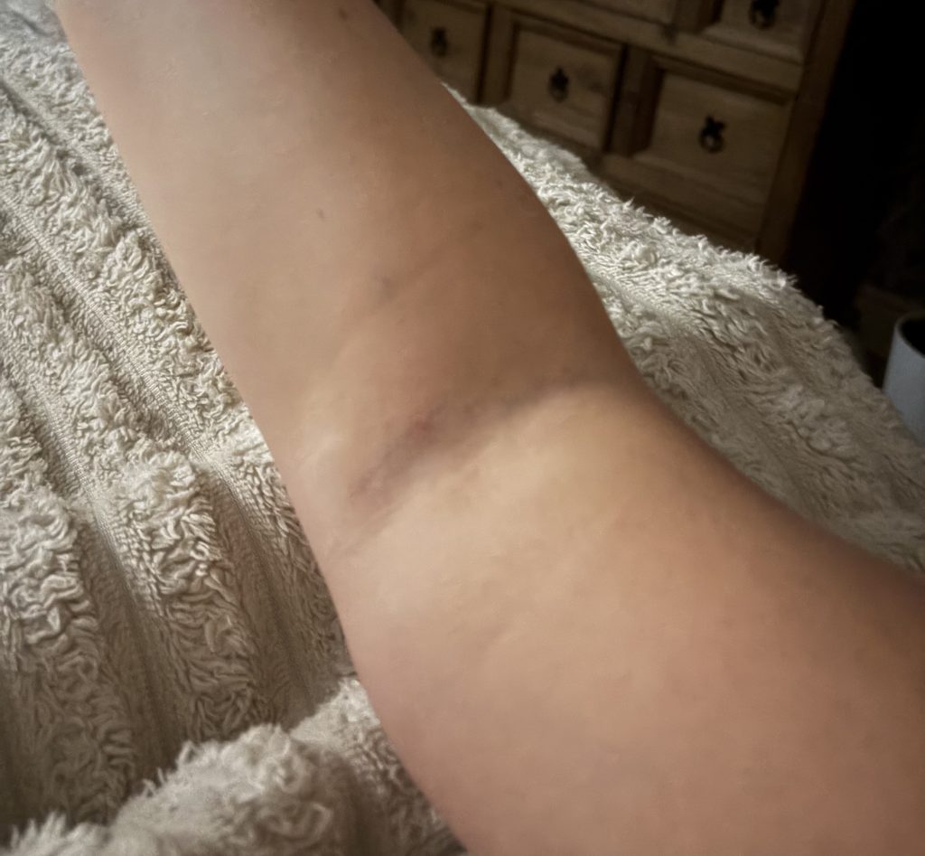A woman claims she left A&E unable to dress, cook or lift a kettle for weeks after a 'bent' cannula was inserted in her arm - with four nurses insisting it looked fine.