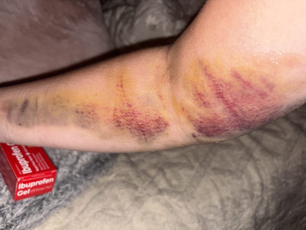 A woman claims she left A&E unable to dress, cook or lift a kettle for weeks after a 'bent' cannula was inserted in her arm - with four nurses insisting it looked fine.