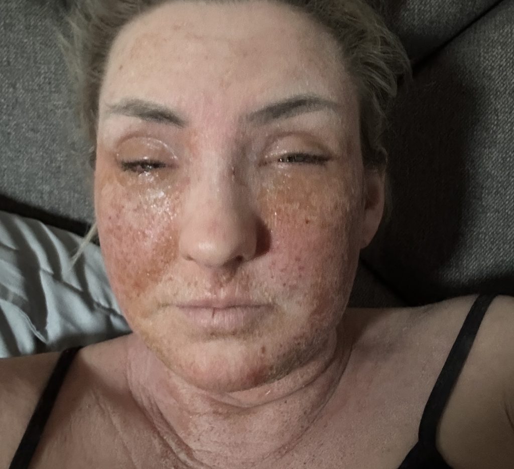 A teacher prescribed steroid eczema creams since she was just six months old says stopping them left her face unrecognisable and skin cracked and oozing from every inch.