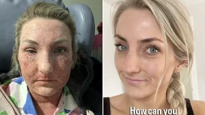 A teacher prescribed steroid eczema creams since she was just six months old says stopping them left her face unrecognisable and skin cracked and oozing from every inch.