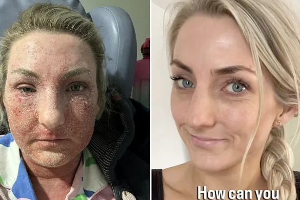 A teacher prescribed steroid eczema creams since she was just six months old says stopping them left her face unrecognisable and skin cracked and oozing from every inch.