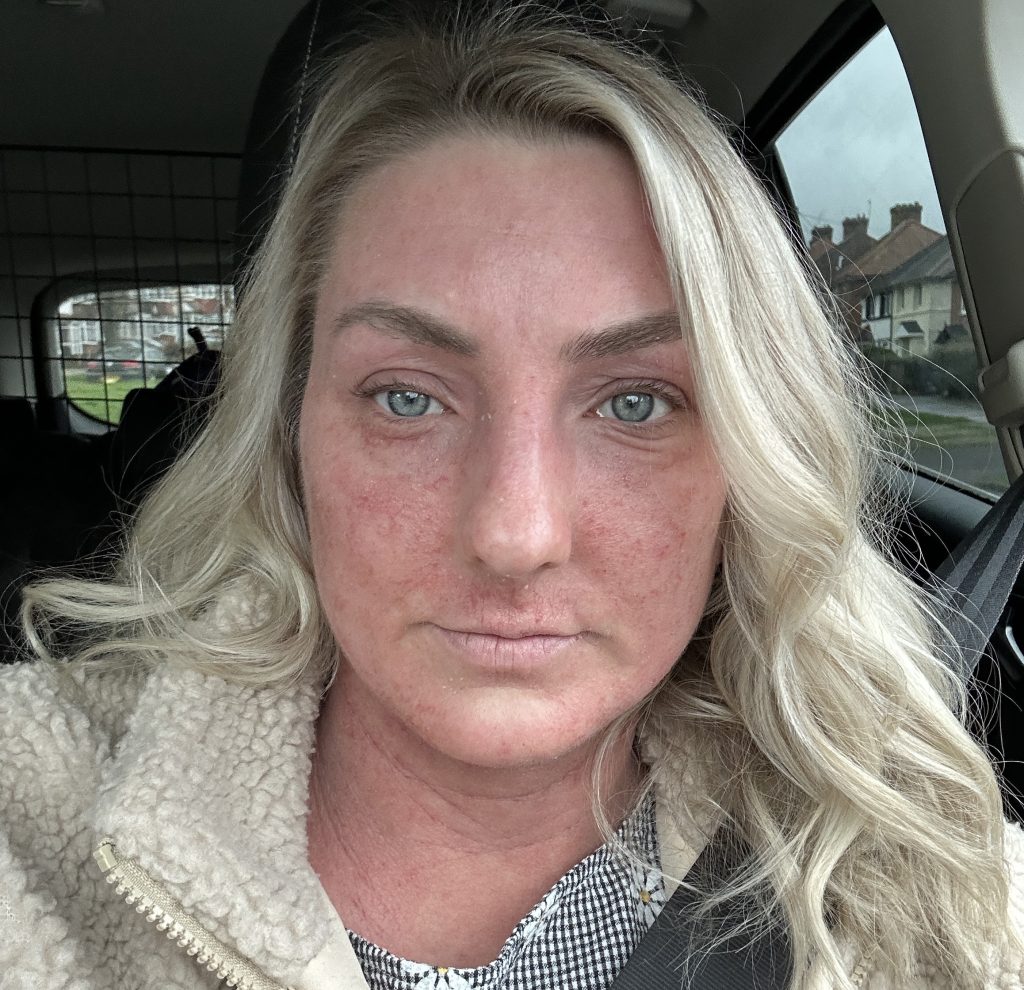 A teacher prescribed steroid eczema creams since she was just six months old says stopping them left her face unrecognisable and skin cracked and oozing from every inch.
