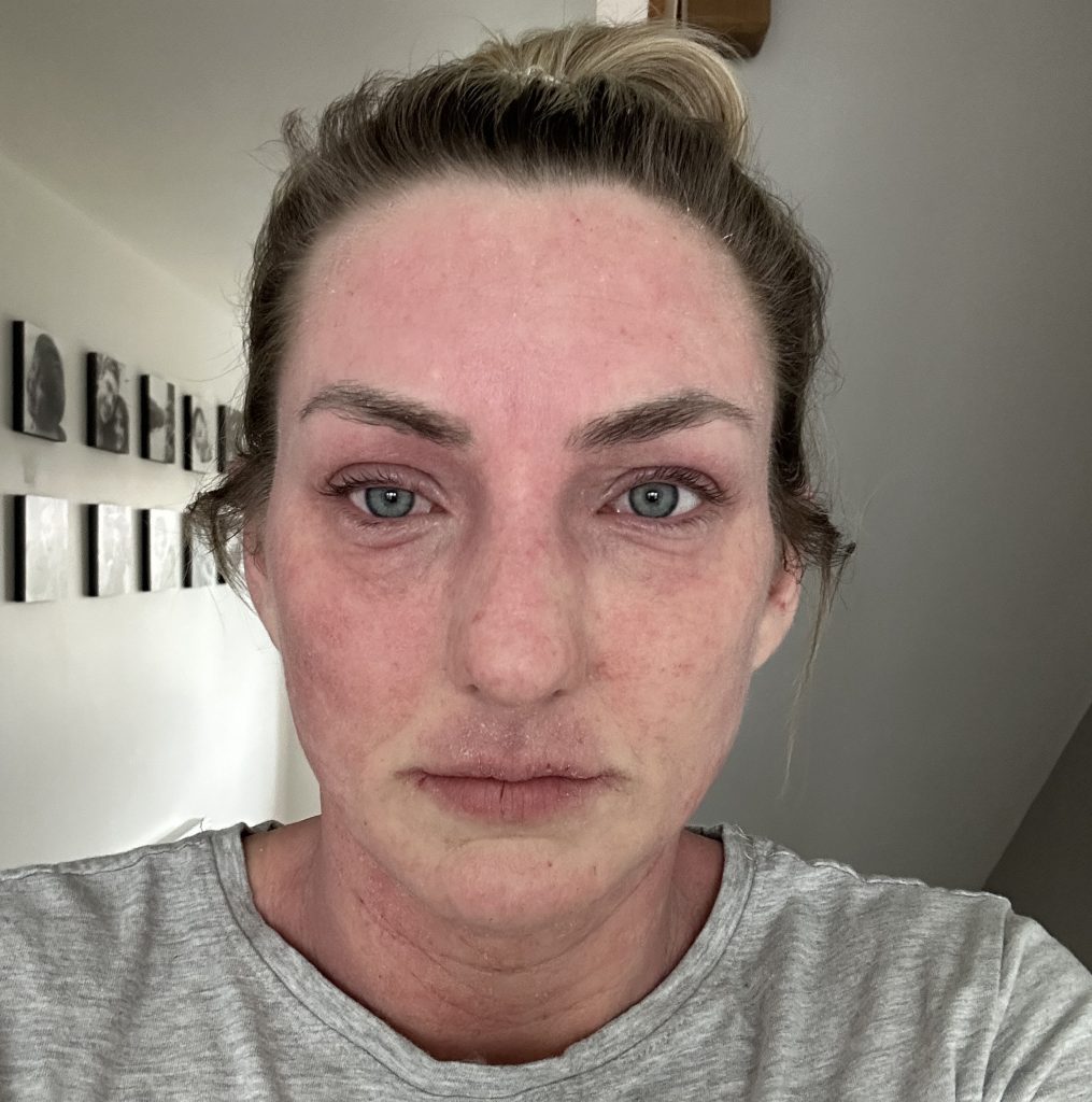 A teacher prescribed steroid eczema creams since she was just six months old says stopping them left her face unrecognisable and skin cracked and oozing from every inch.