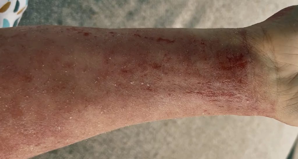 A teacher prescribed steroid eczema creams since she was just six months old says stopping them left her face unrecognisable and skin cracked and oozing from every inch.