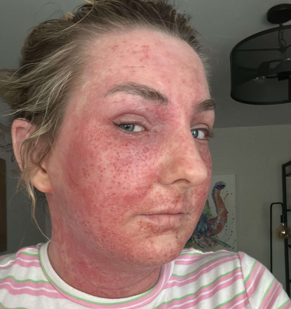 A teacher prescribed steroid eczema creams since she was just six months old says stopping them left her face unrecognisable and skin cracked and oozing from every inch.