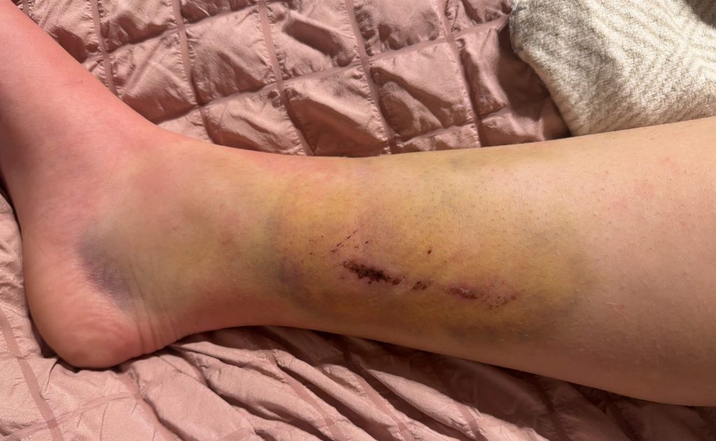 Teen Libby Partridge thought she was "a gonner" after her horse bolted and kicked her in the head - and says one piece of kit saved her life.