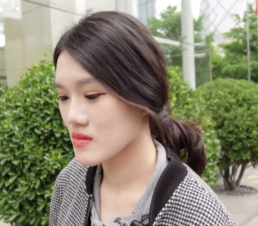 Woman, 24, went in for routine dental fillings but a botched jaw op left her face uneven and looking like an ancient Chinese emperor with a pronounced underbite.