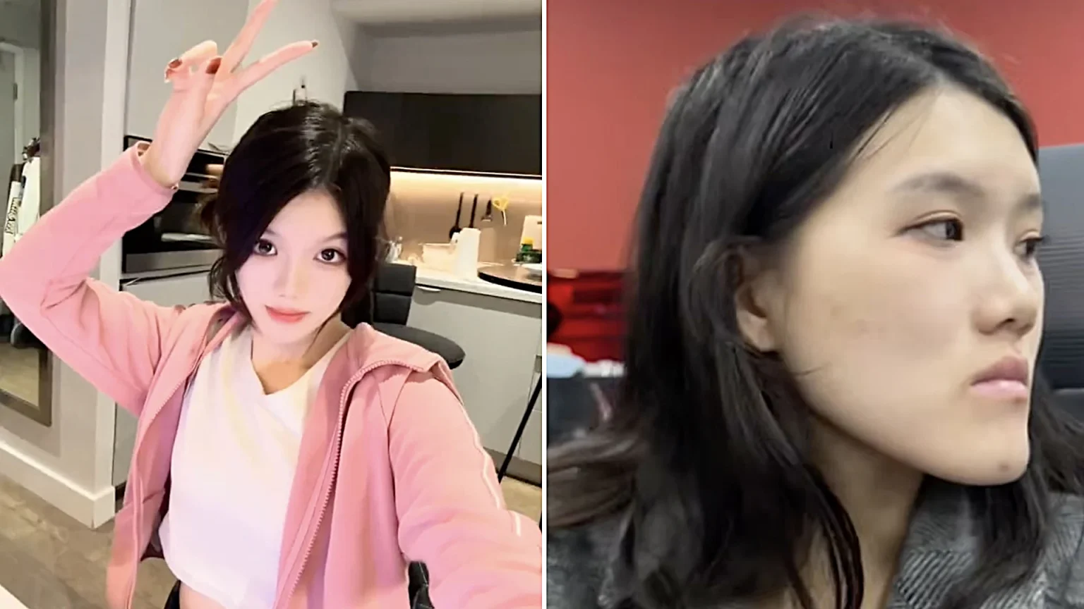 Woman, 24, went in for routine dental fillings but a botched jaw op left her face uneven and looking like an ancient Chinese emperor with a pronounced underbite.