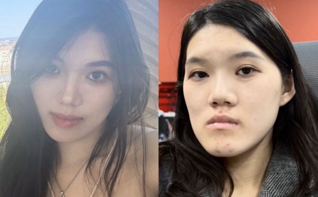 Woman, 24, went in for routine dental fillings but a botched jaw op left her face uneven and looking like an ancient Chinese emperor with a pronounced underbite.