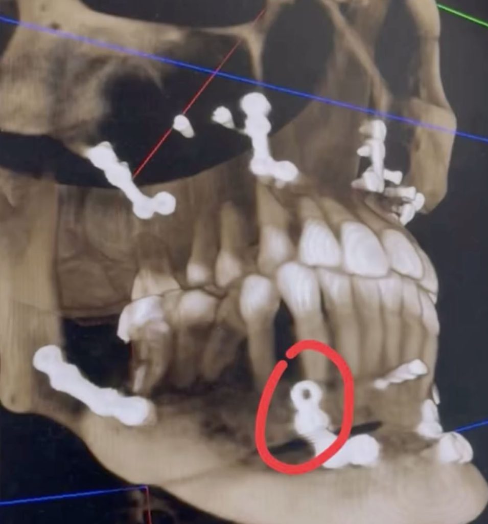 Woman, 24, went in for routine dental fillings but a botched jaw op left her face uneven and looking like an ancient Chinese emperor with a pronounced underbite.