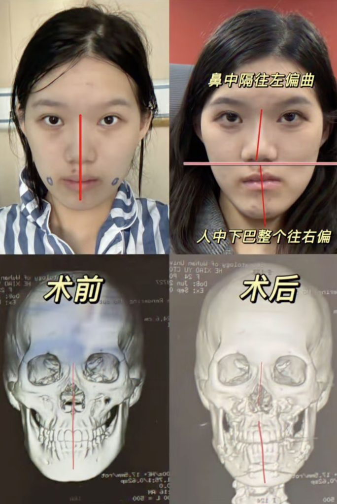 Woman, 24, went in for routine dental fillings but a botched jaw op left her face uneven and looking like an ancient Chinese emperor with a pronounced underbite.