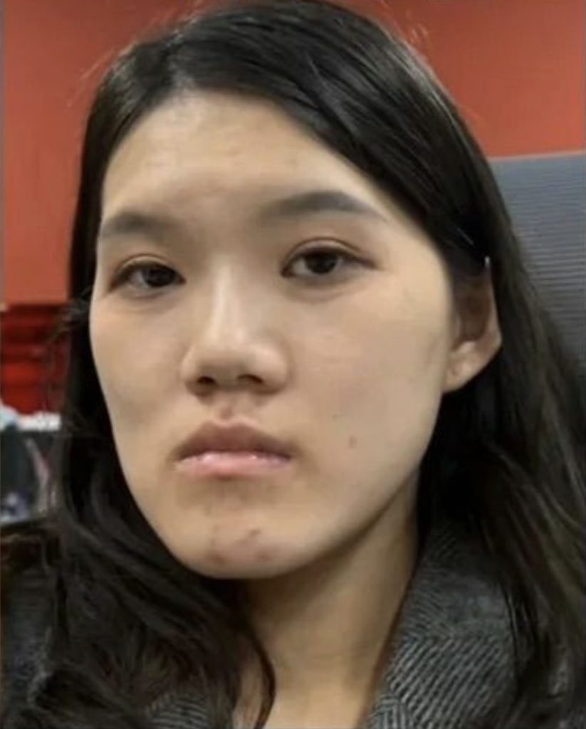 Woman, 24, went in for routine dental fillings but a botched jaw op left her face uneven and looking like an ancient Chinese emperor with a pronounced underbite.