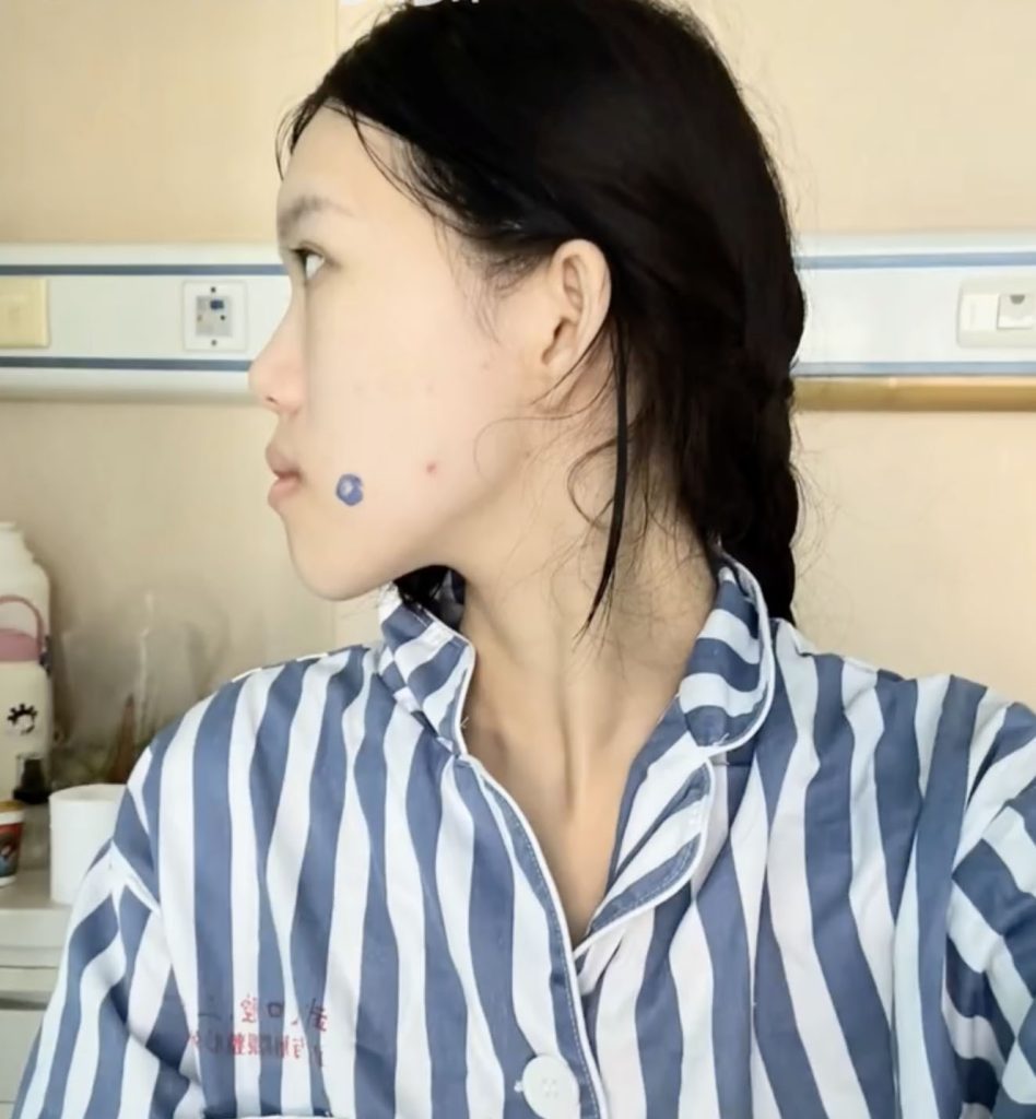 Woman, 24, went in for routine dental fillings but a botched jaw op left her face uneven and looking like an ancient Chinese emperor with a pronounced underbite.