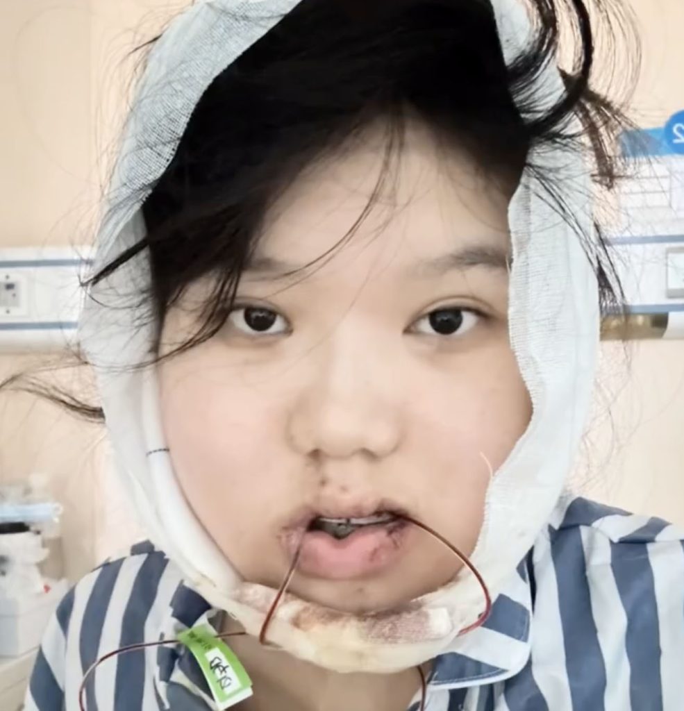 Woman, 24, went in for routine dental fillings but a botched jaw op left her face uneven and looking like an ancient Chinese emperor with a pronounced underbite.