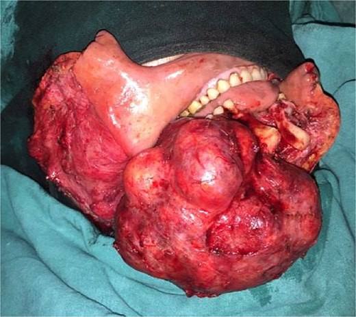 A 27-year-old baffled doctors with her enormous jaw - a rare bone tumour had taken over, forcing surgeons to remove a section and rebuild her face with bone from her leg.
