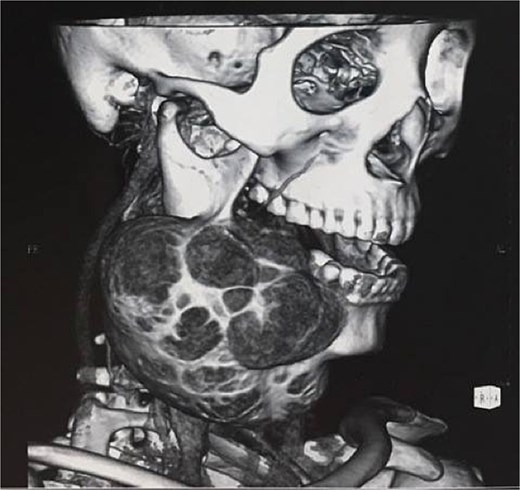 A 27-year-old baffled doctors with her enormous jaw - a rare bone tumour had taken over, forcing surgeons to remove a section and rebuild her face with bone from her leg.