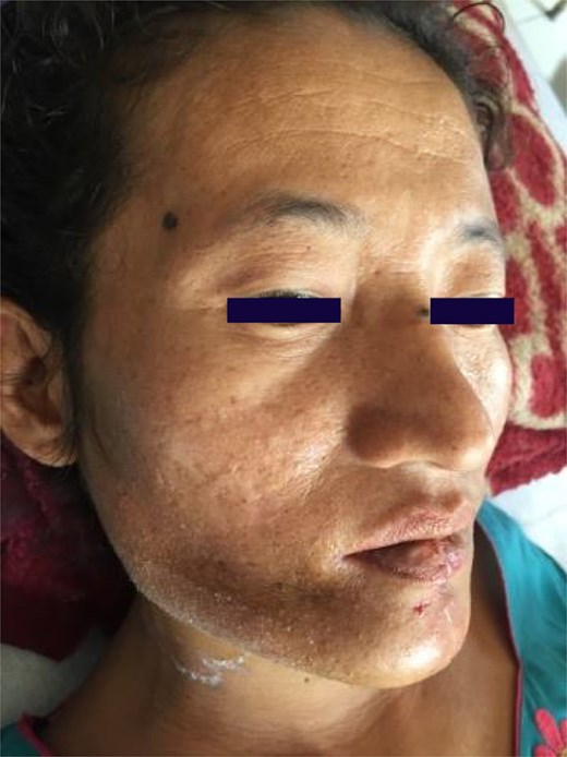 A 27-year-old baffled doctors with her enormous jaw - a rare bone tumour had taken over, forcing surgeons to remove a section and rebuild her face with bone from her leg.