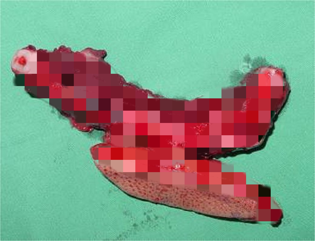 A 27-year-old baffled doctors with her enormous jaw - a rare bone tumour had taken over, forcing surgeons to remove a section and rebuild her face with bone from her leg.