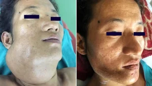 A 27-year-old baffled doctors with her enormous jaw - a rare bone tumour had taken over, forcing surgeons to remove a section and rebuild her face with bone from her leg.