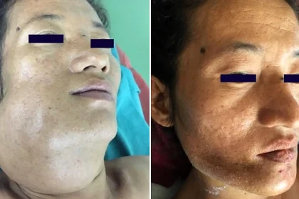 A 27-year-old baffled doctors with her enormous jaw - a rare bone tumour had taken over, forcing surgeons to remove a section and rebuild her face with bone from her leg.