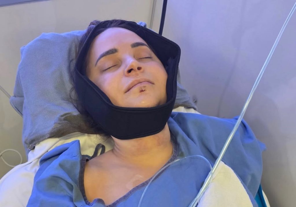 YouTube star Rosanna Pansino shattered her jaw in four places and smashed her front teeth after a horror fall as a boat docked on her birthday - she now has four metal screws in her gums.