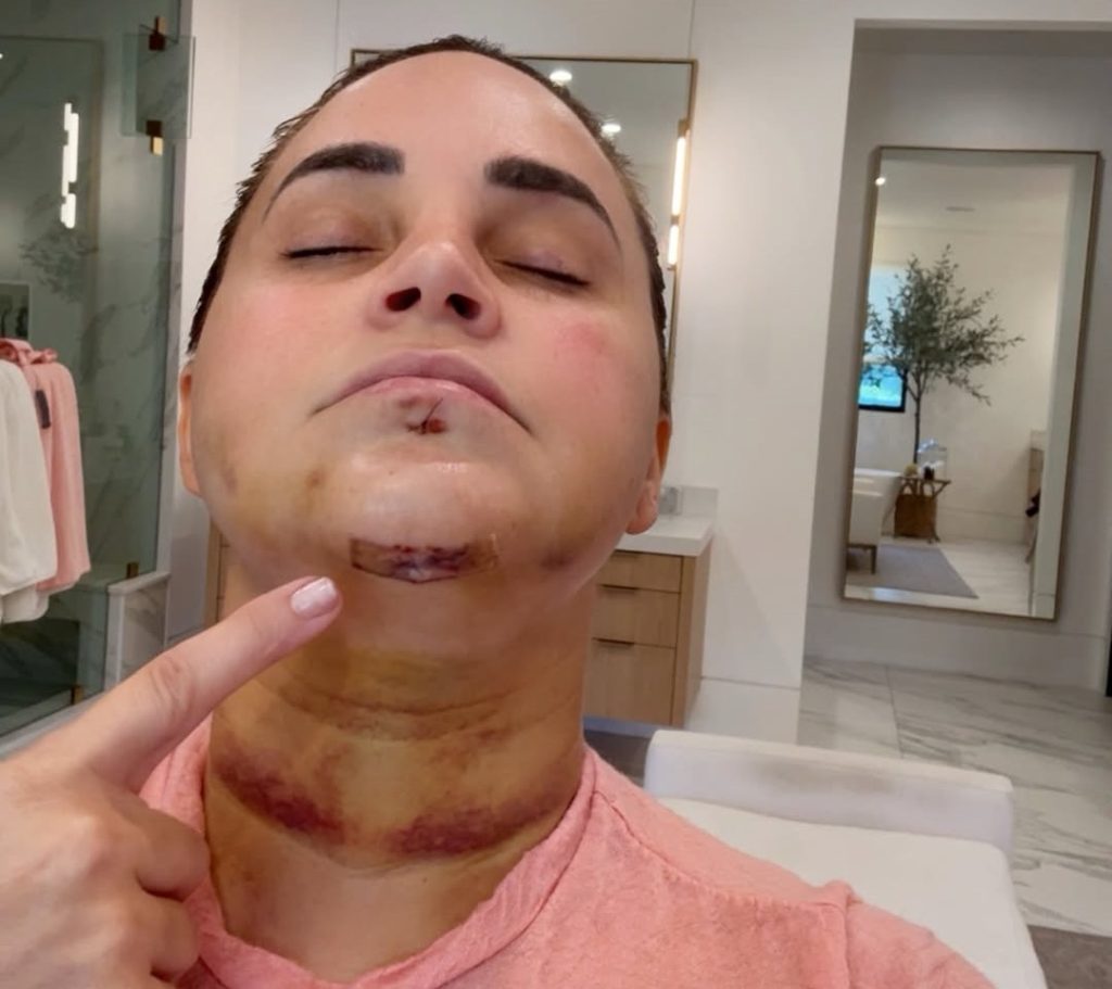 YouTube star Rosanna Pansino shattered her jaw in four places and smashed her front teeth after a horror fall as a boat docked on her birthday - she now has four metal screws in her gums.