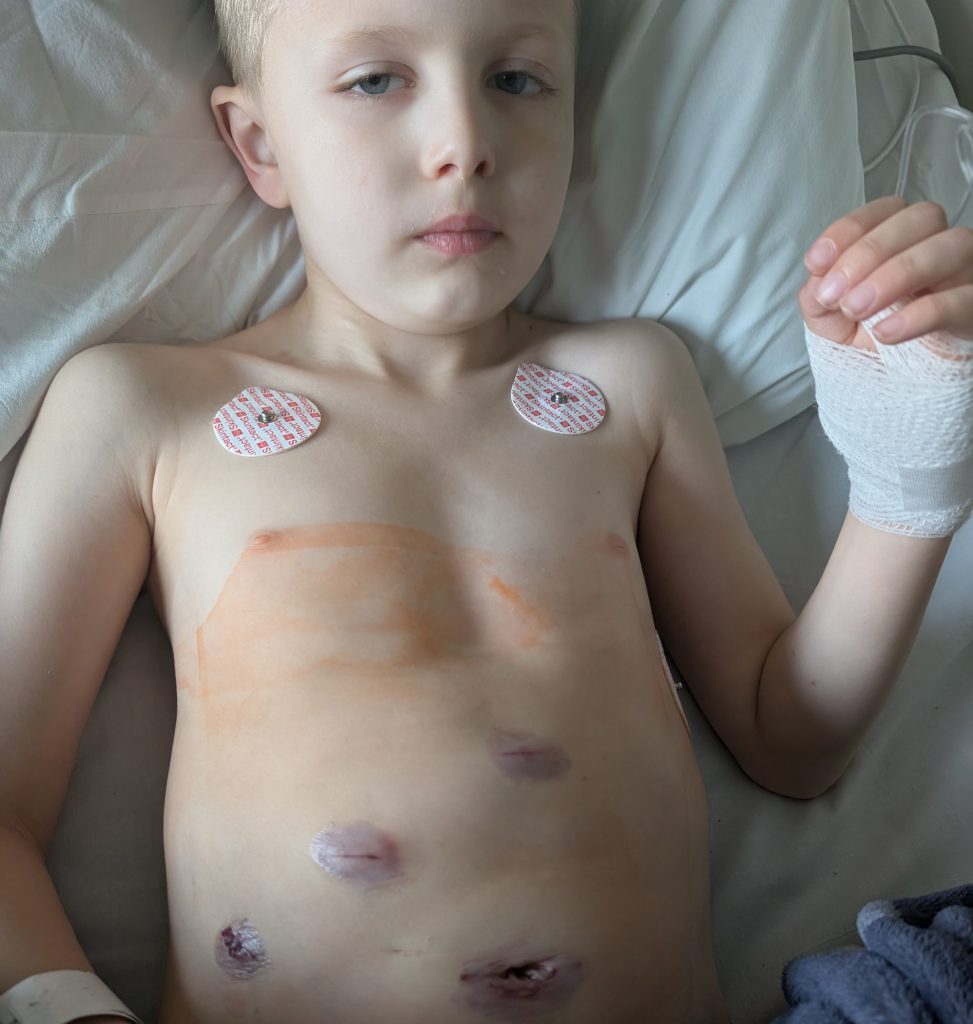 Mum thought toddler had holiday food poisoning in Egypt - but it was deadly E.coli that triggered a rare condition and left him fighting for his life.