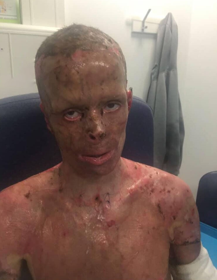Darren Harris was clinically dead for 14 minutes after 11,000 volts burned him to the bone - now he's undergone 33 surgeries and needs £100,000 for facial reconstruction.