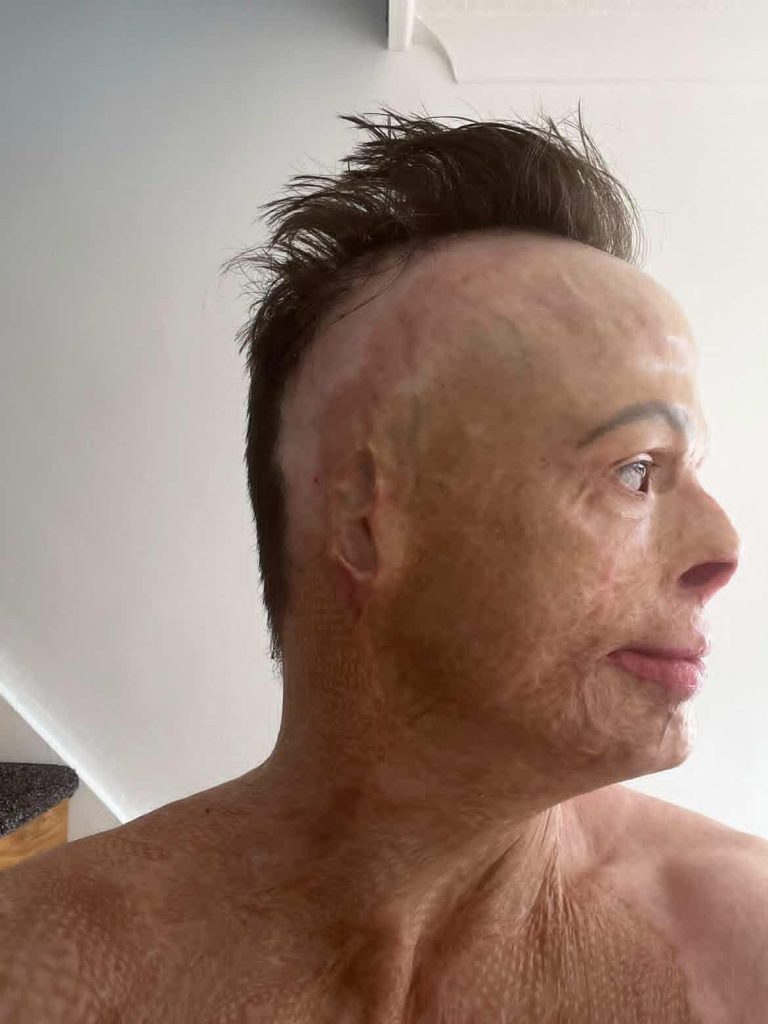 Darren Harris was clinically dead for 14 minutes after 11,000 volts burned him to the bone - now he's undergone 33 surgeries and needs £100,000 for facial reconstruction.