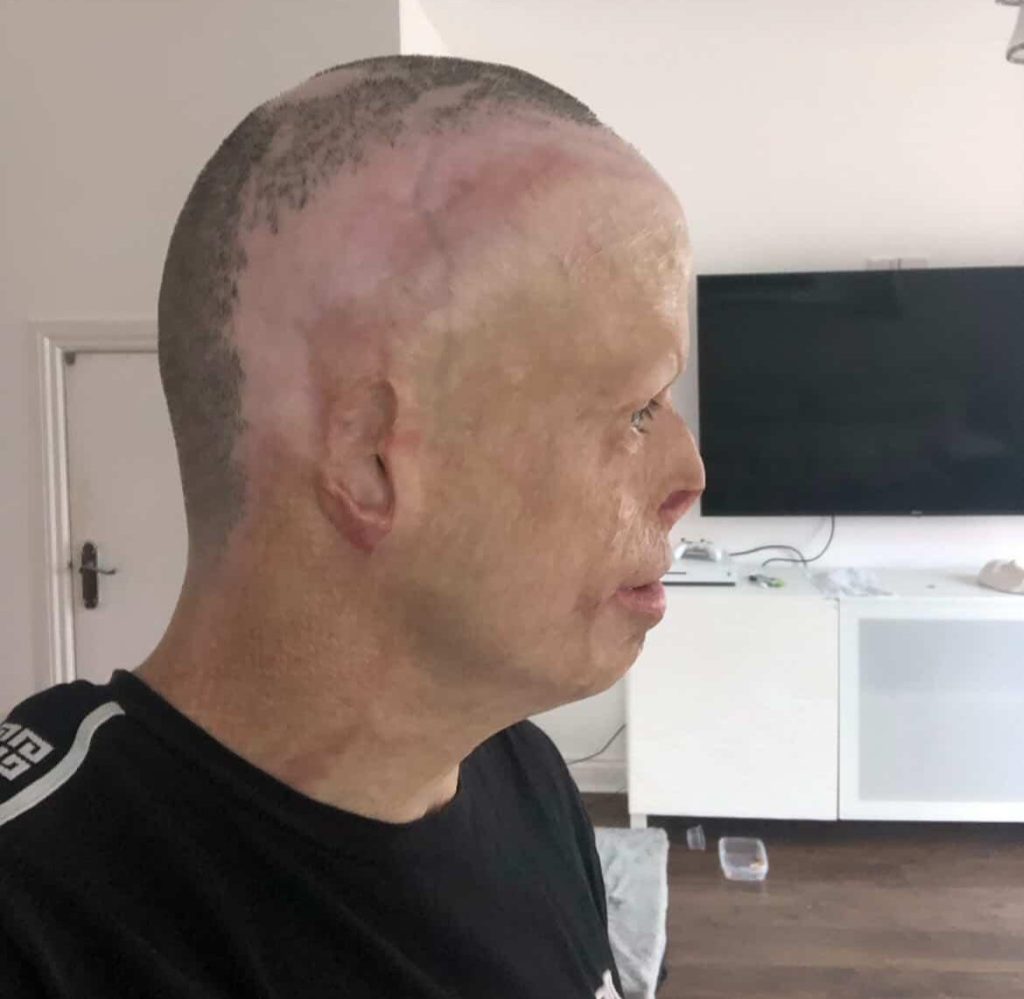 Darren Harris was clinically dead for 14 minutes after 11,000 volts burned him to the bone - now he's undergone 33 surgeries and needs £100,000 for facial reconstruction.