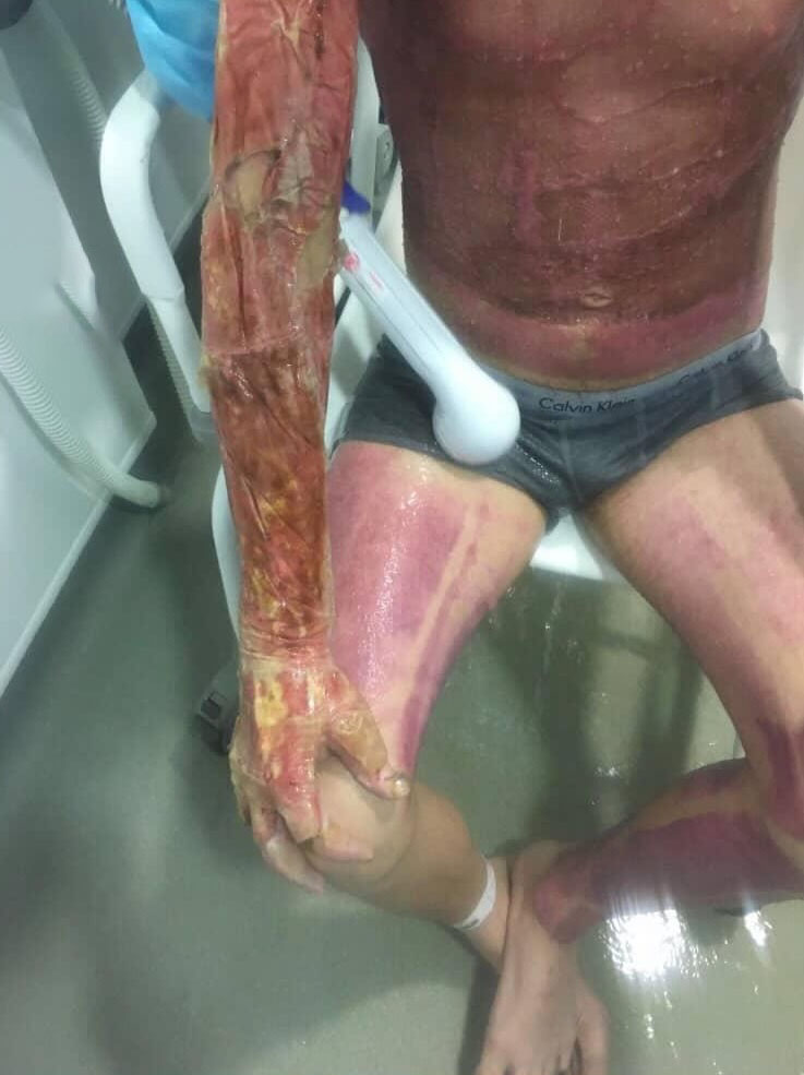Darren Harris was clinically dead for 14 minutes after 11,000 volts burned him to the bone - now he's undergone 33 surgeries and needs £100,000 for facial reconstruction.
