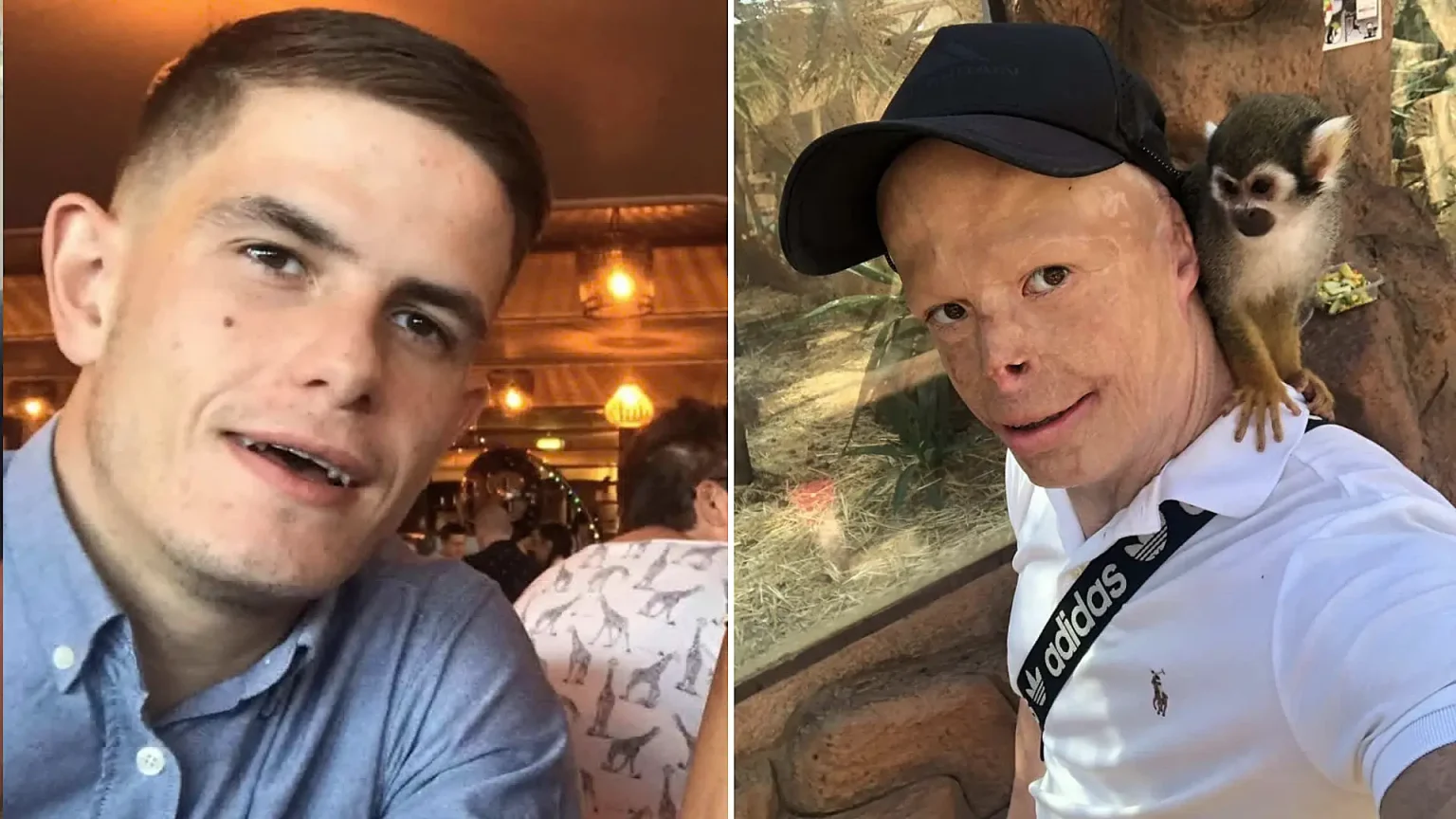 Darren Harris was clinically dead for 14 minutes after 11,000 volts burned him to the bone - now he's undergone 33 surgeries and needs £100,000 for facial reconstruction.