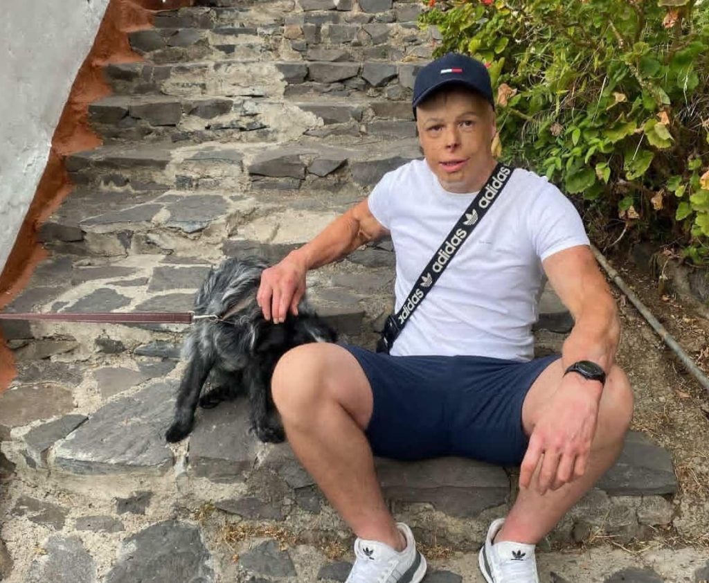 Darren Harris was clinically dead for 14 minutes after 11,000 volts burned him to the bone - now he's undergone 33 surgeries and needs £100,000 for facial reconstruction.
