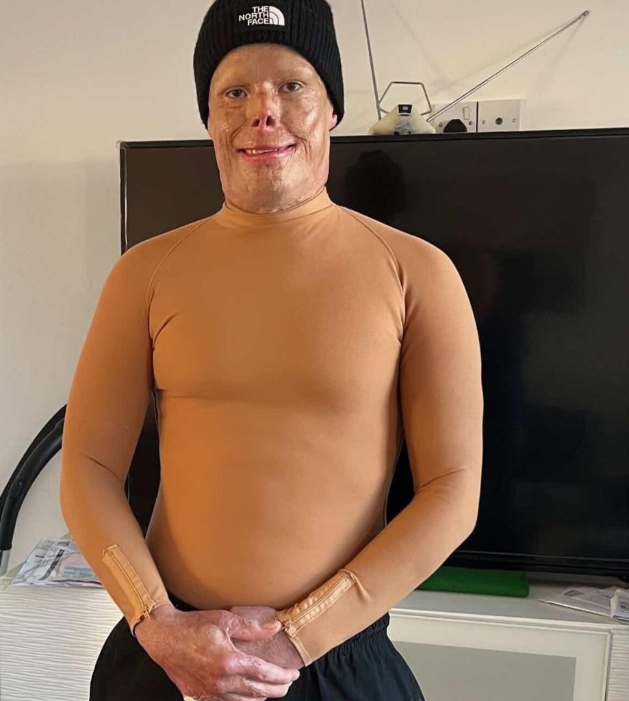 Darren Harris was clinically dead for 14 minutes after 11,000 volts burned him to the bone - now he's undergone 33 surgeries and needs £100,000 for facial reconstruction.