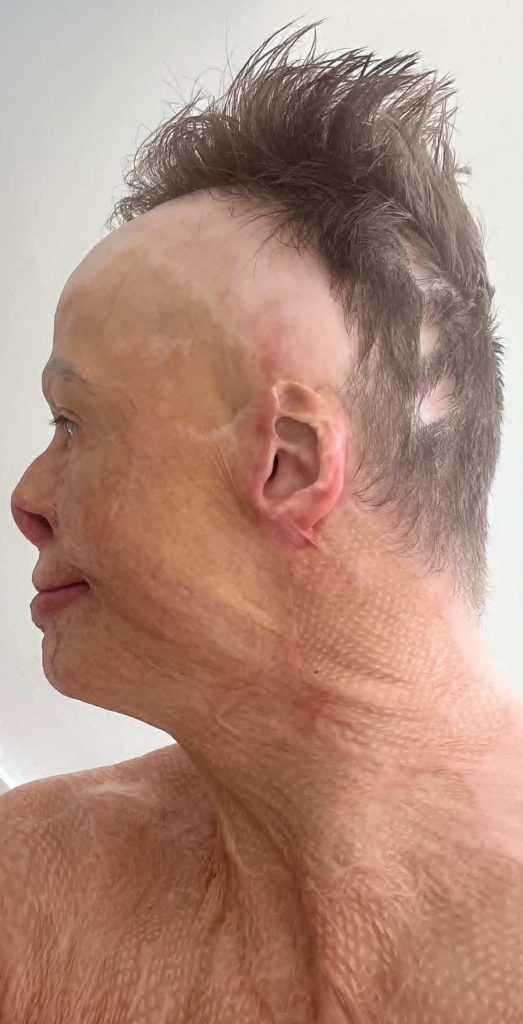 Darren Harris was clinically dead for 14 minutes after 11,000 volts burned him to the bone - now he's undergone 33 surgeries and needs £100,000 for facial reconstruction.