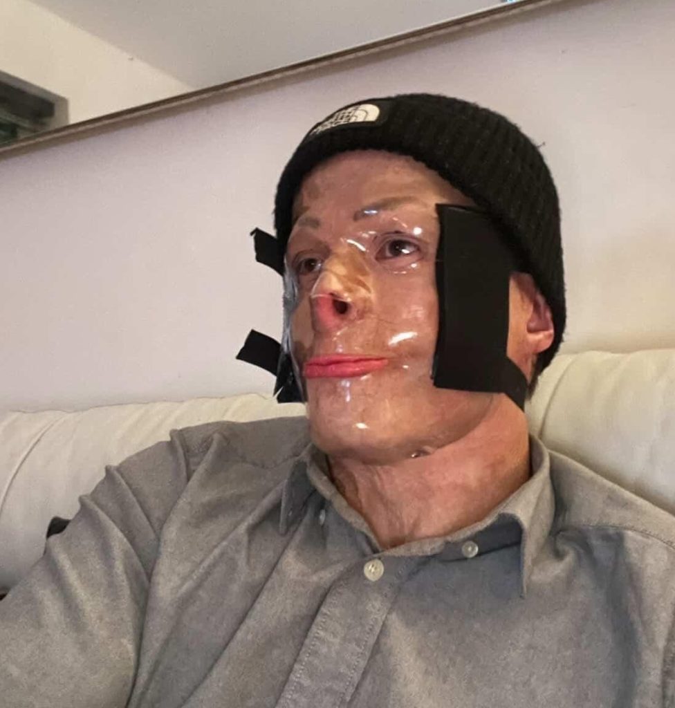 Darren Harris was clinically dead for 14 minutes after 11,000 volts burned him to the bone - now he's undergone 33 surgeries and needs £100,000 for facial reconstruction.