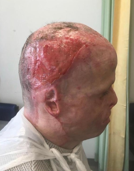 Darren Harris was clinically dead for 14 minutes after 11,000 volts burned him to the bone - now he's undergone 33 surgeries and needs £100,000 for facial reconstruction.