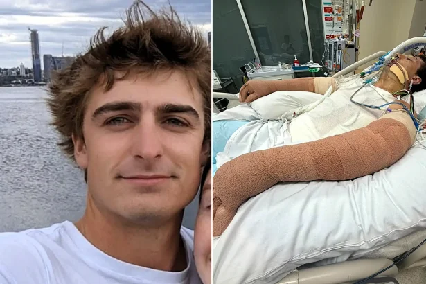 A man who suffered burns to 75% of his body when a robot vacuum exploded in his face has hit a major recovery milestone in Australia - having his feeding tube removed.
