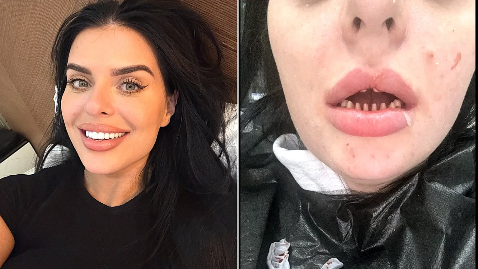 Celebrity make-up artist devastated after discovering the 24 crowns she got in Turkey were actually 16 teeth joined together as bridges - now facing up to £15,000 to fix it.