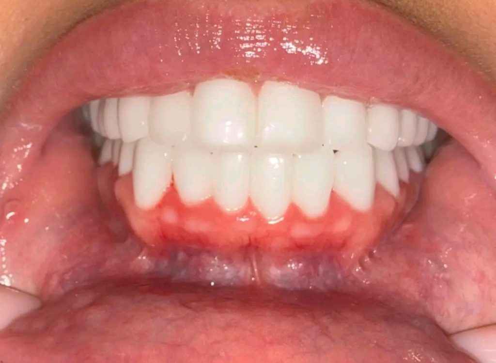 Celebrity make-up artist devastated after discovering the 24 crowns she got in Turkey were actually 16 teeth joined together as bridges - now facing up to £15,000 to fix it.
